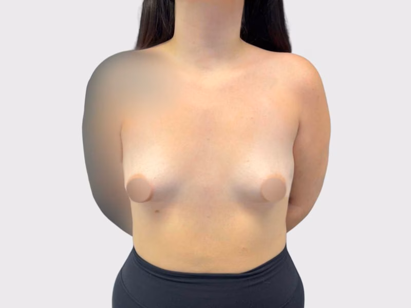 Breast Lift Case 2 before view for surgical case review