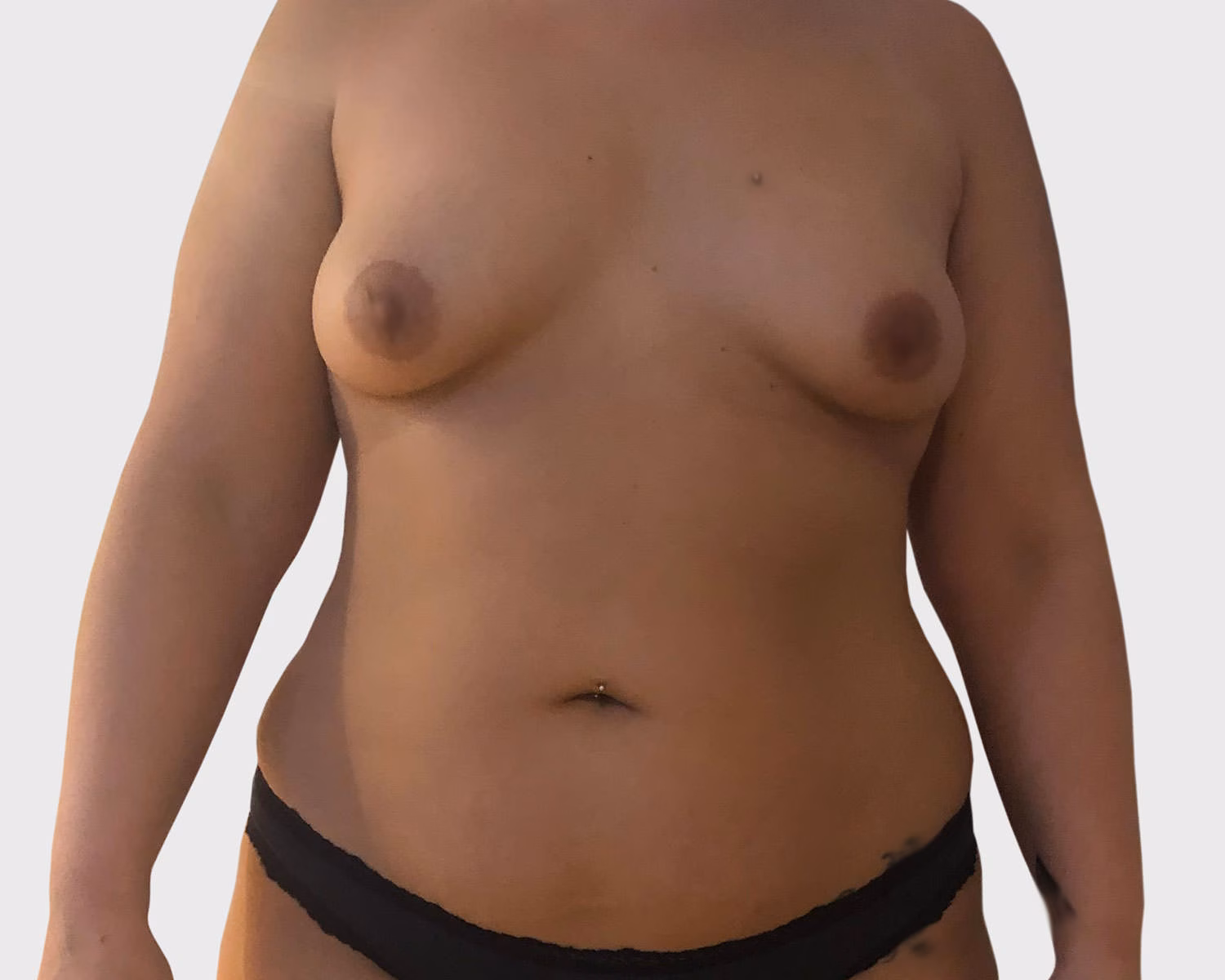 Breast Lift Case 3 before view for surgical case review